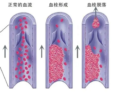 男子遭多次刑讯逼供后死亡11人被判刑 新闻里说静脉血栓形成并脱落，一直没理解时候