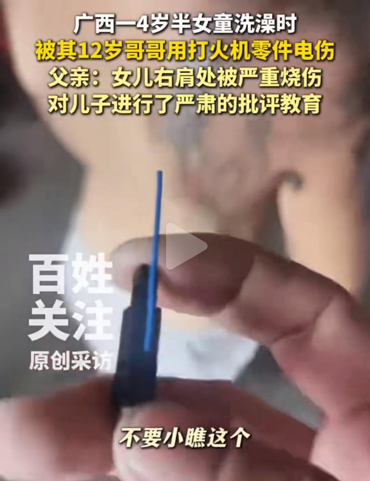 4岁娃洗澡时被12岁哥哥电到烧伤，她爹居然说“就是俩娃闹着玩”？这事儿搁谁看了不