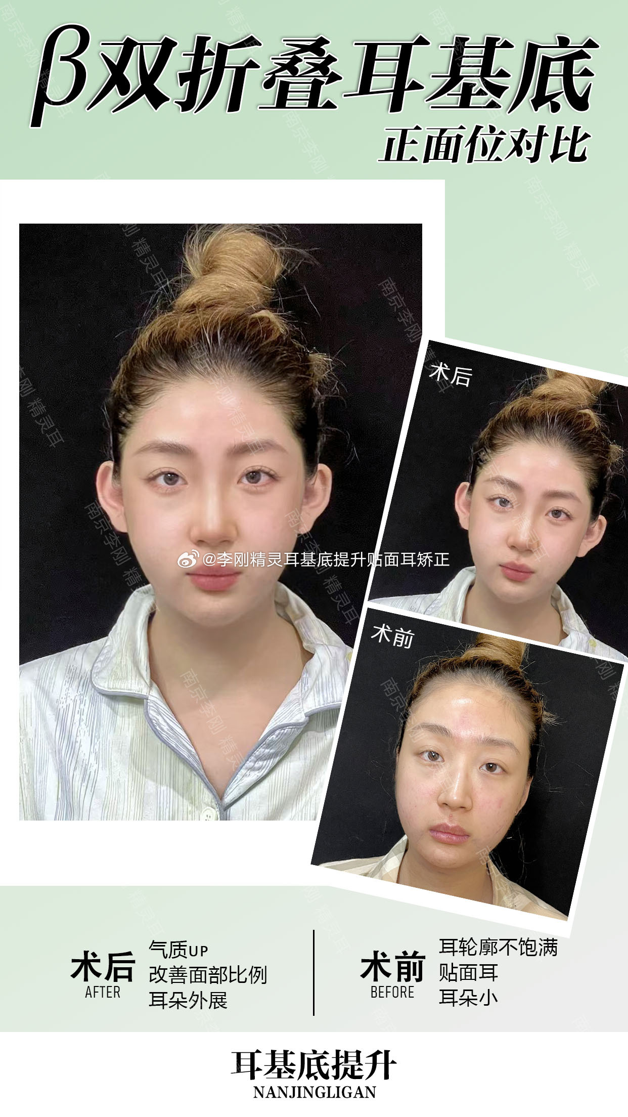 大家最担心的两个点：切口在哪、留不留疤。咱们膨体耳基底提升，入路切口选在隐蔽褶皱