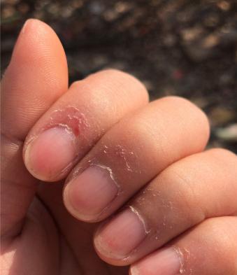 悲剧还是发生了！12月5日，湖南长沙，一女子见右手手指上有根倒刺，就顺手拔掉了，