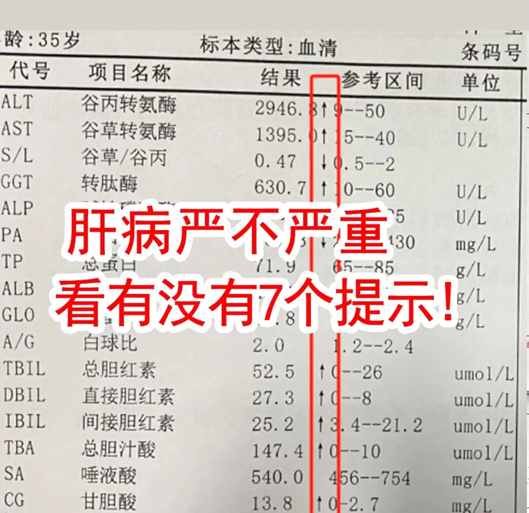肝病严不严重，看看报告单上有没有7个提示。①谷丙转氨酶和谷草转氨酶升高...