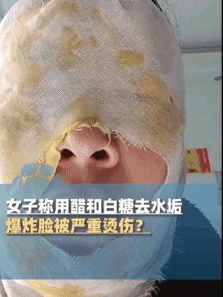 女子模仿网络妙招除水垢，保温壶爆炸致面部严重烫伤！

河北邯郸的吴女士经历了一场