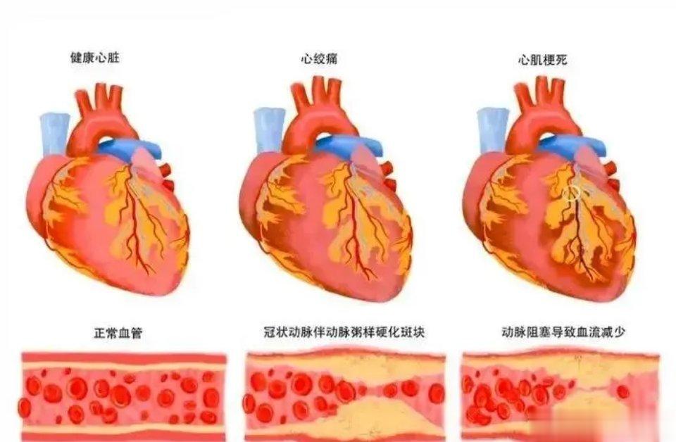 心脑血管疾病的危险因素大致有9种：1. 年龄增长55岁后每增加10岁，脑卒中的风