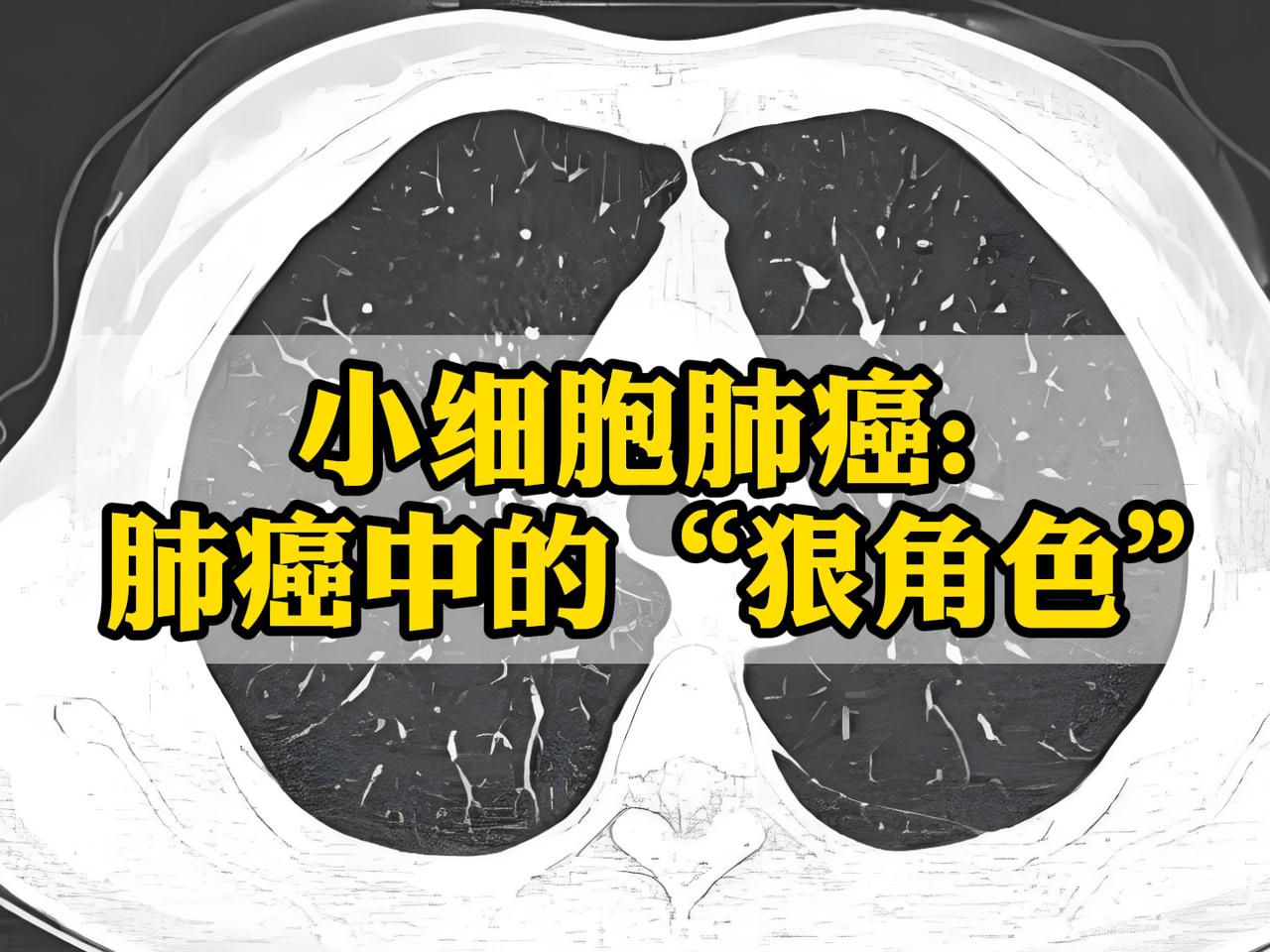 在肺癌家族里，有一类肿瘤格外“凶猛”，它就是小细胞肺癌。它生长快、转移早、凶险度