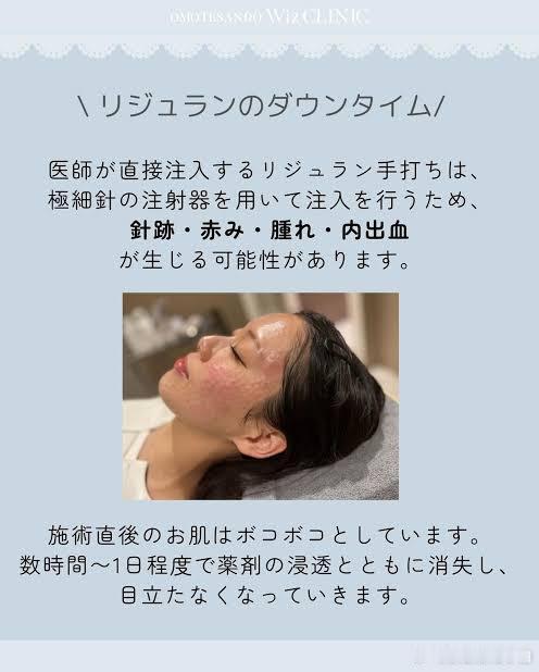 日本医美  第二次来做リジュラン注射了💉这次操作的医师🧑⚕️很年轻很认真，一