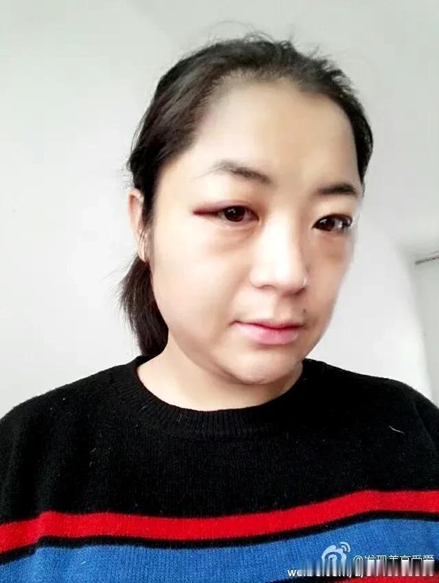 第一张是婚内被打的我，第二张是今天的我。
现在讨厌以前那个卑微到骨子里的自己，怕
