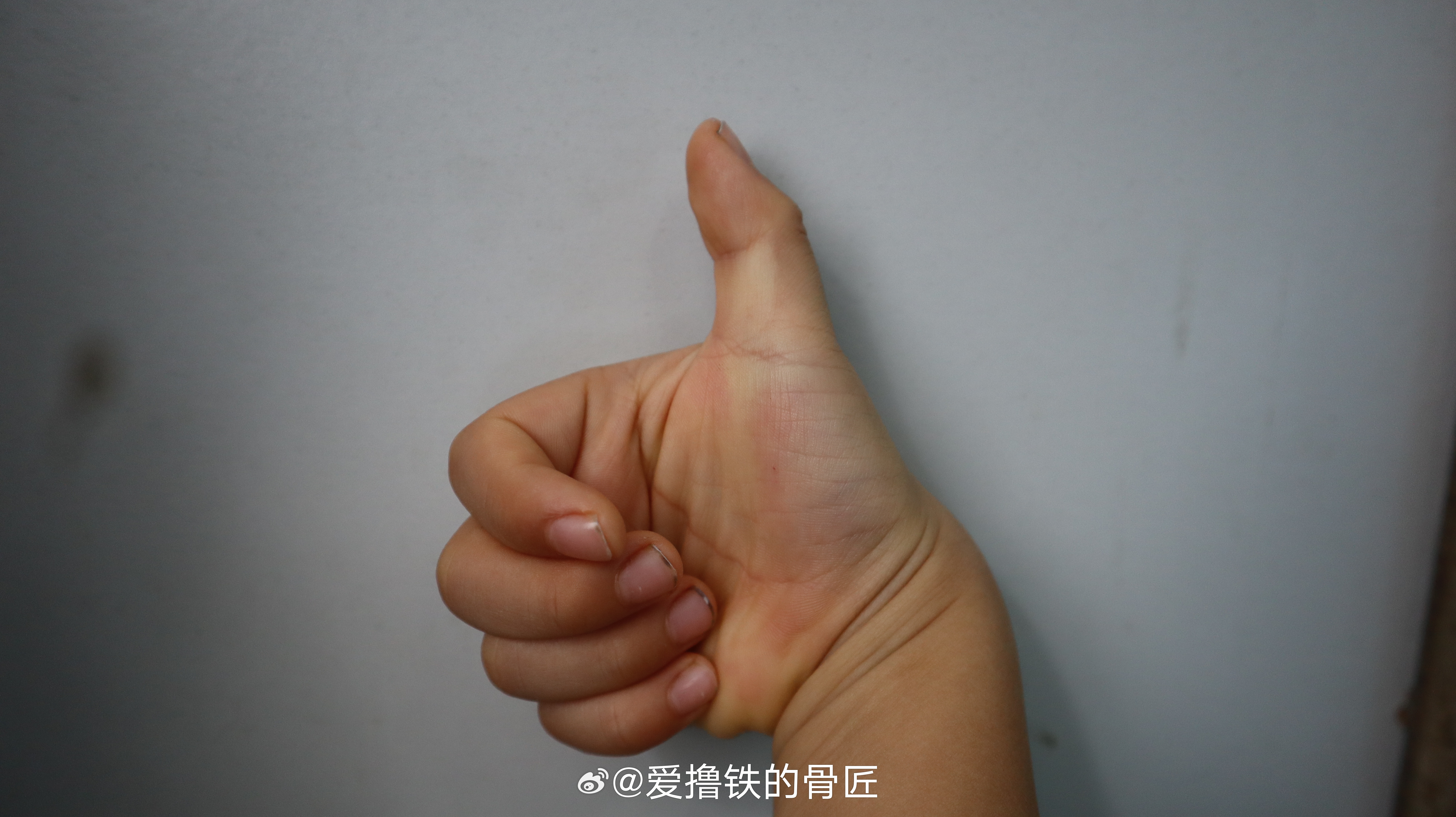 6岁小朋友，也想为奥运健儿加油，不过这个拇指造型是不是有点问题？确实，先天性狭窄