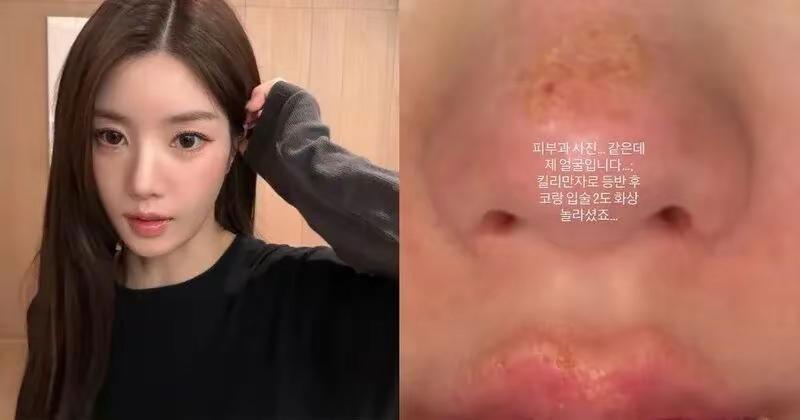 人气女偶像脸部二度烫伤！亲自公开脸部受损照！粉丝吓坏心忧！ 韩人气歌手 权恩妃 