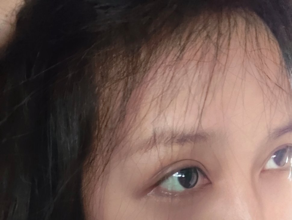 老卷哼哧哼哧认真养发了几个月的结果，头顶没有这么明显，但是发际线可以说是意外之喜