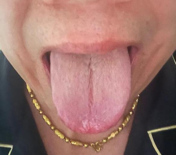 评论区看到的舌象[灵光一闪]，瞎吃药，自己却吃的一团糟
他舌尖很红，潘医生确定，