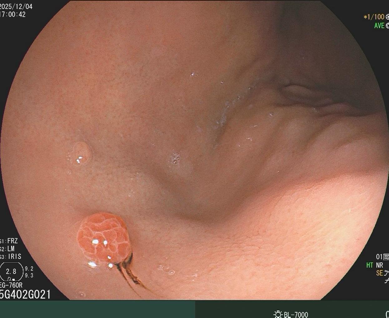 哇哦，树莓哎。小凹上皮肿瘤伴高级别上皮内瘤变，日常工作中并不常见，可惜...