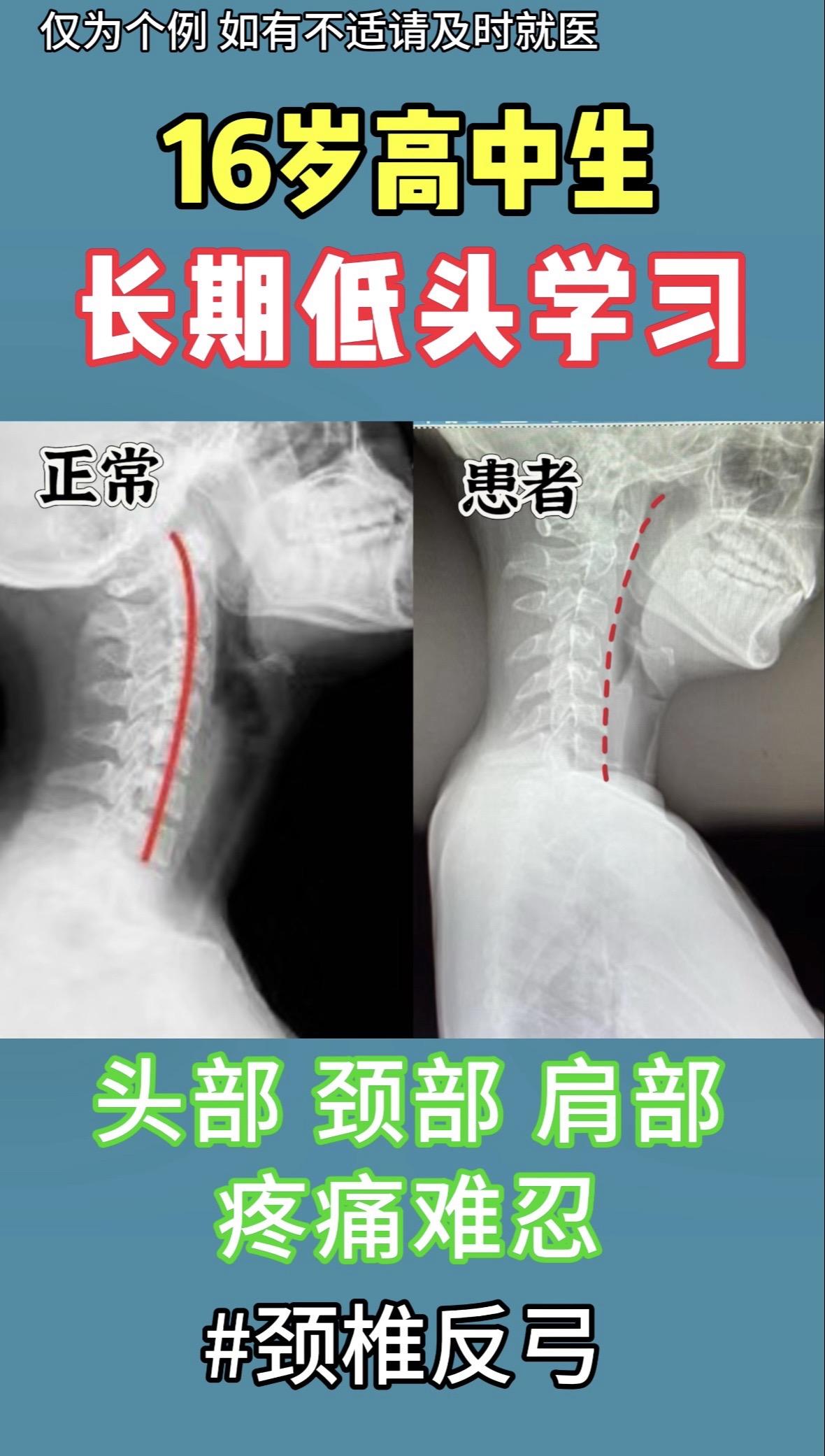 16岁高中生，长期低头学习，颈椎反弓。头部、颈部、肩部疼痛难忍。刚哥提...
