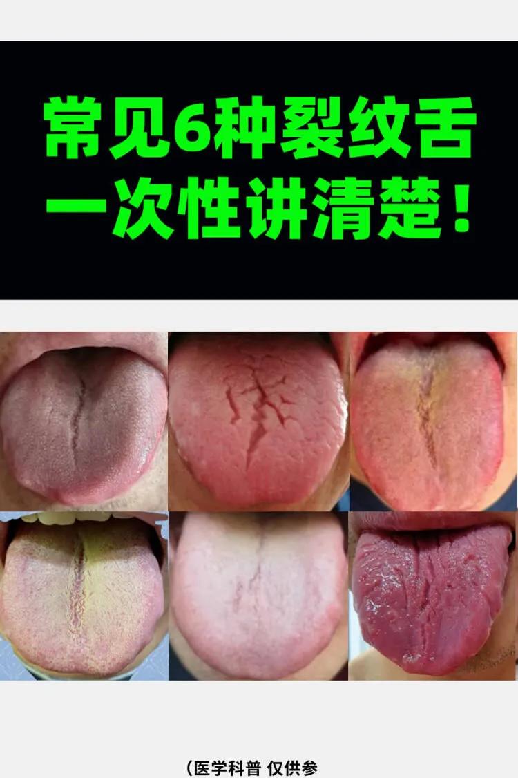 常见裂纹舌，看看是哪种#脾胃##裂纹舌# #舌诊#