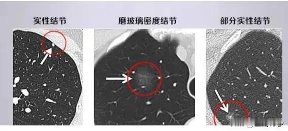 肺部结节只要出现这几种表现，就基本上可以排除肺癌的可能性了

在医学领域，肺部结