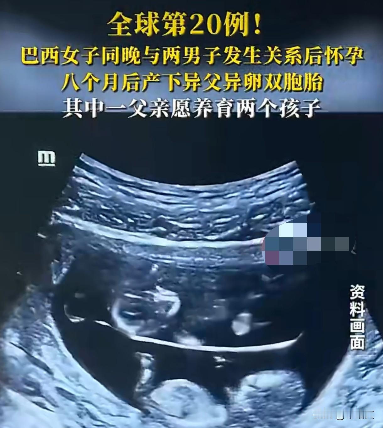 巴西双胞胎不同爹？全球仅20例，这操作颠覆认知！
 
巴西一女子生下双胞胎，八个