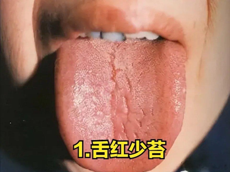 失眠常见的5种类型，舌象帮你准确辨证，看看你是哪一种？ 1、营血蕴热型失眠表现：