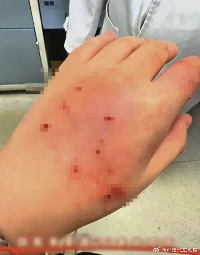 胖哥汽车频道[超话]坐顺风车被车主自带狐獴咬伤 这事不好说，车主为啥携带异宠、是