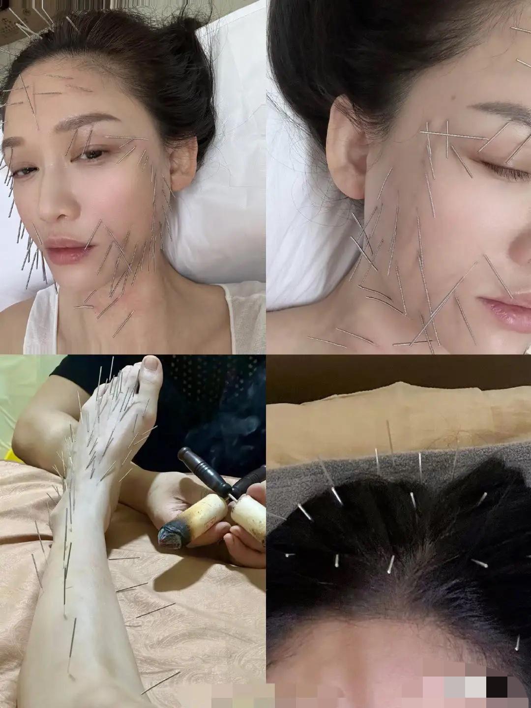 陈乔恩对自己也太狠了吧！
我是头一次看到这种针灸，脸上、头顶、腿上扎了有上百根针