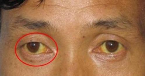 肝硬化来临前最常见的4个信号！
一、全身症状：
由于肝脏出现硬化，患者会感觉到长