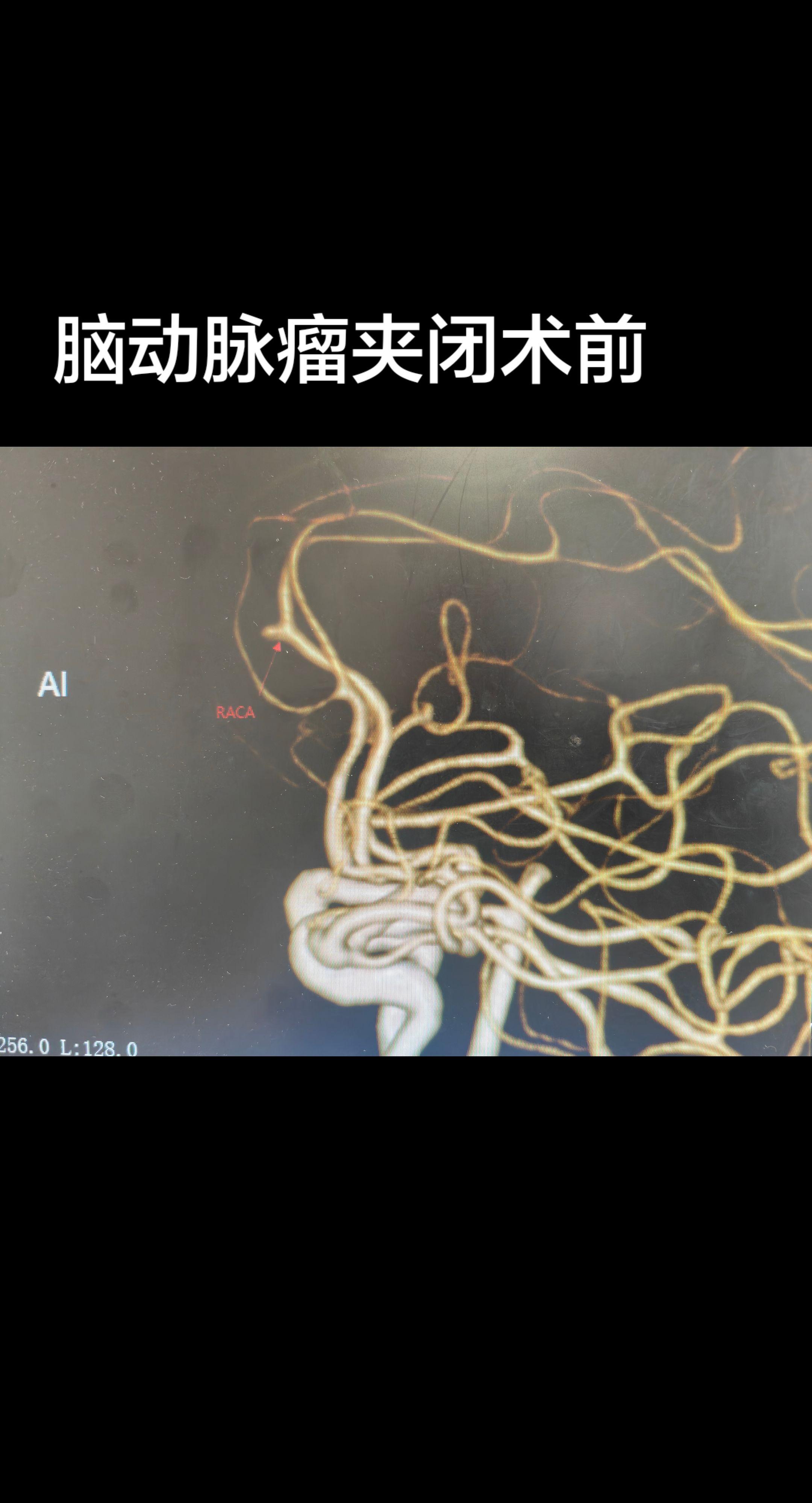 脑动脉瘤破裂开颅夹闭
