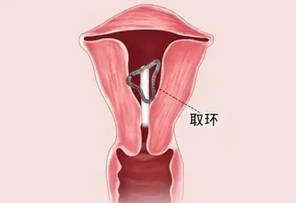 “离大谱！”辽宁，一女子到医院取避孕环，可手术完后，女子发现腹部经常疼痛，就在她