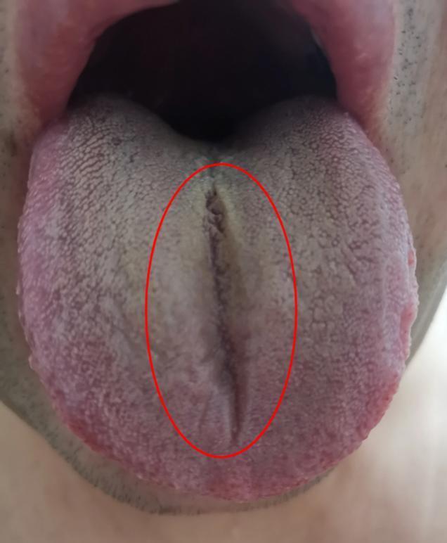舌面有异常，千万不要忽视
这个大兄弟最近总是感觉自己力不从心 哪哪都不舒服，吃了