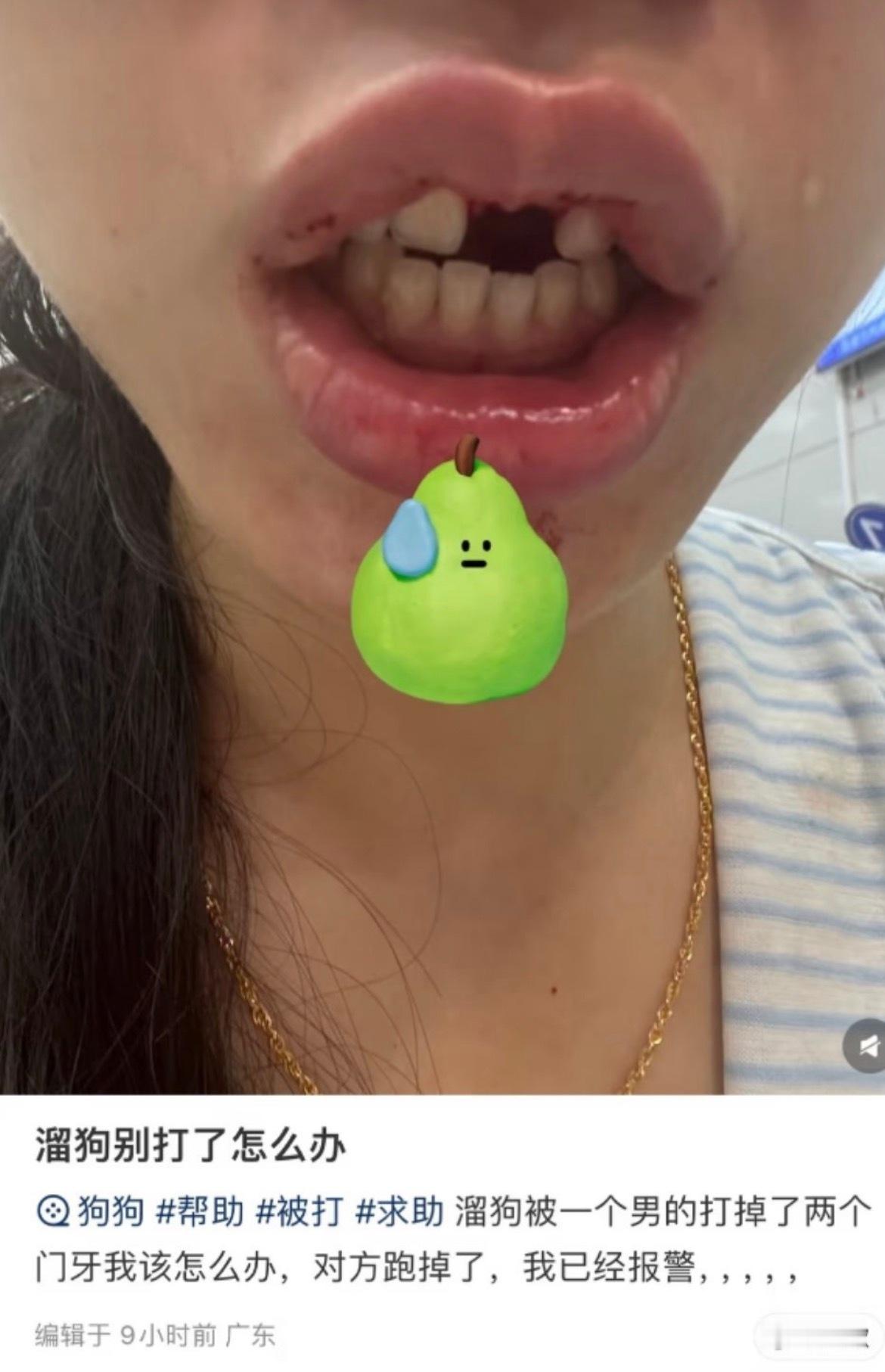 一女学生遛狗被bro打掉门牙… 