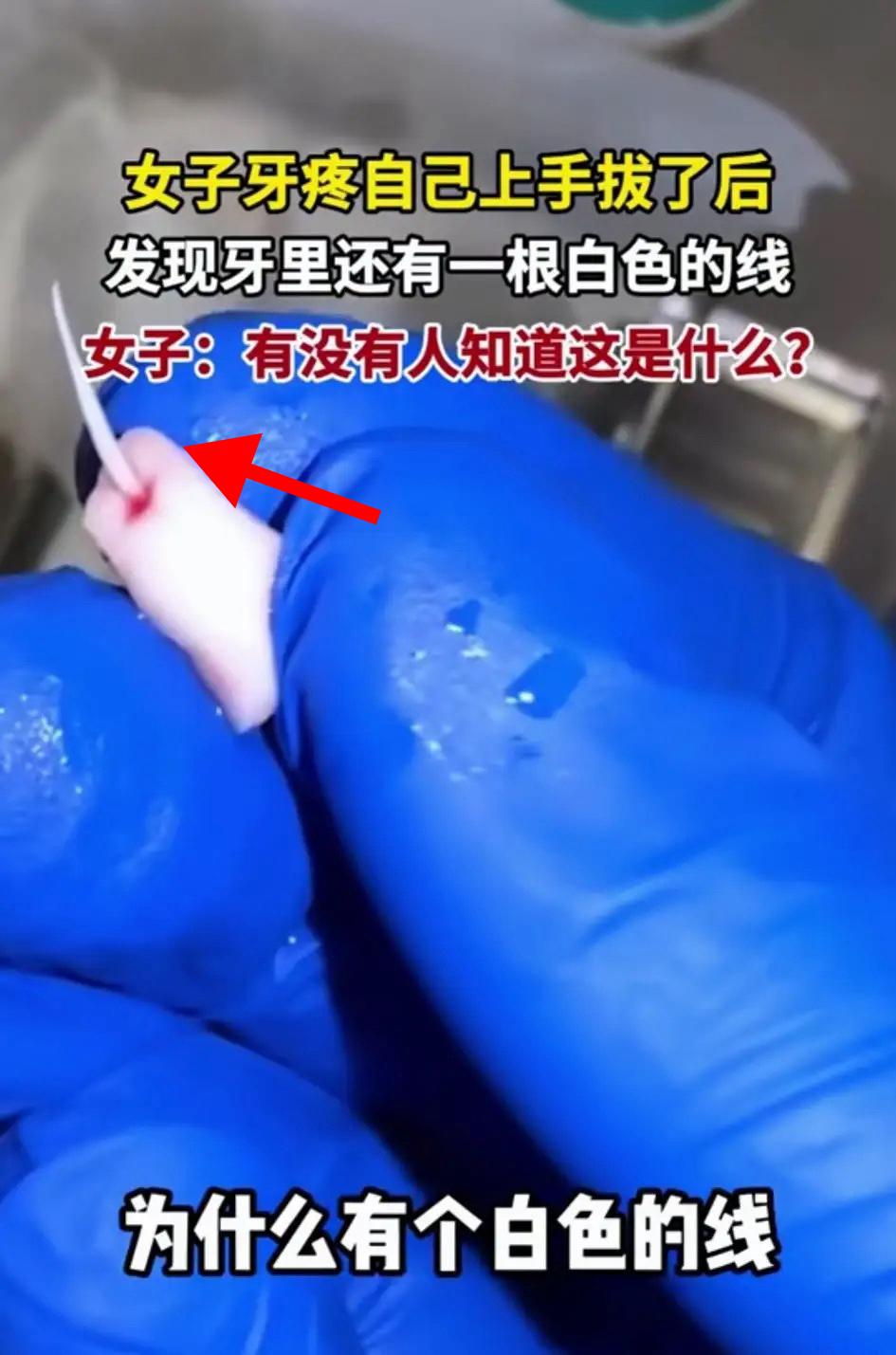 一女子牙疼难耐，
实在忍受不了剧痛，
心一横自己动手把牙拔了。之后竟意外发现牙里