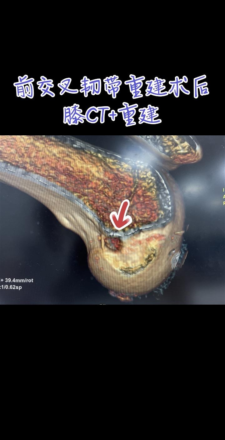 前交叉韧带重建。每一张图片，都是对细节的苛求；每一次重建，都是对精准的不懈探索。