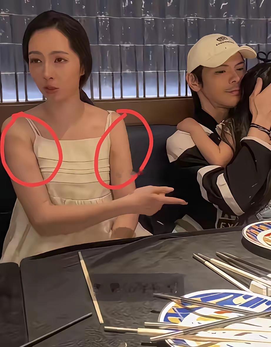 郭碧婷的手上怎么那么多淤青啊？ 