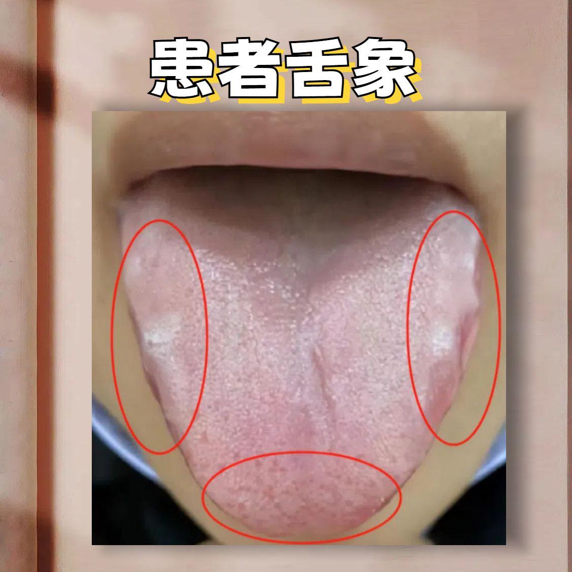 脾胃虚寒还夹杂着寒湿，只用参苓白术散和桂附地黄丸可不管用！

患者主诉：一吃凉的