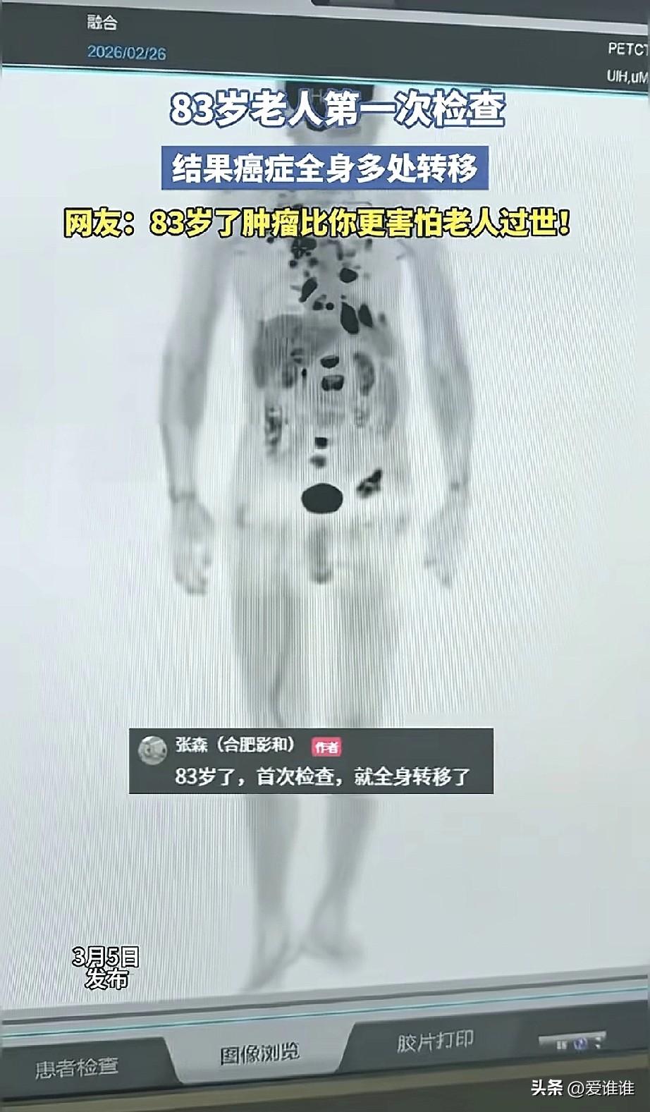 “癌细胞都怕的人！”安徽一位83岁的老爷子，身子骨一直特别硬朗，一辈子生活在农村