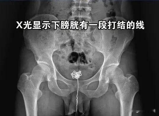 小伙为“爽”把整根电线塞进膀胱，医生取出来时全科室都吐了。说出来你可能不信，有人