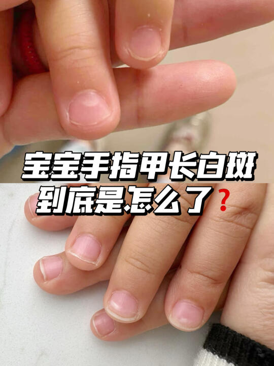 赶紧自查！看看宝宝手指有没有这个！