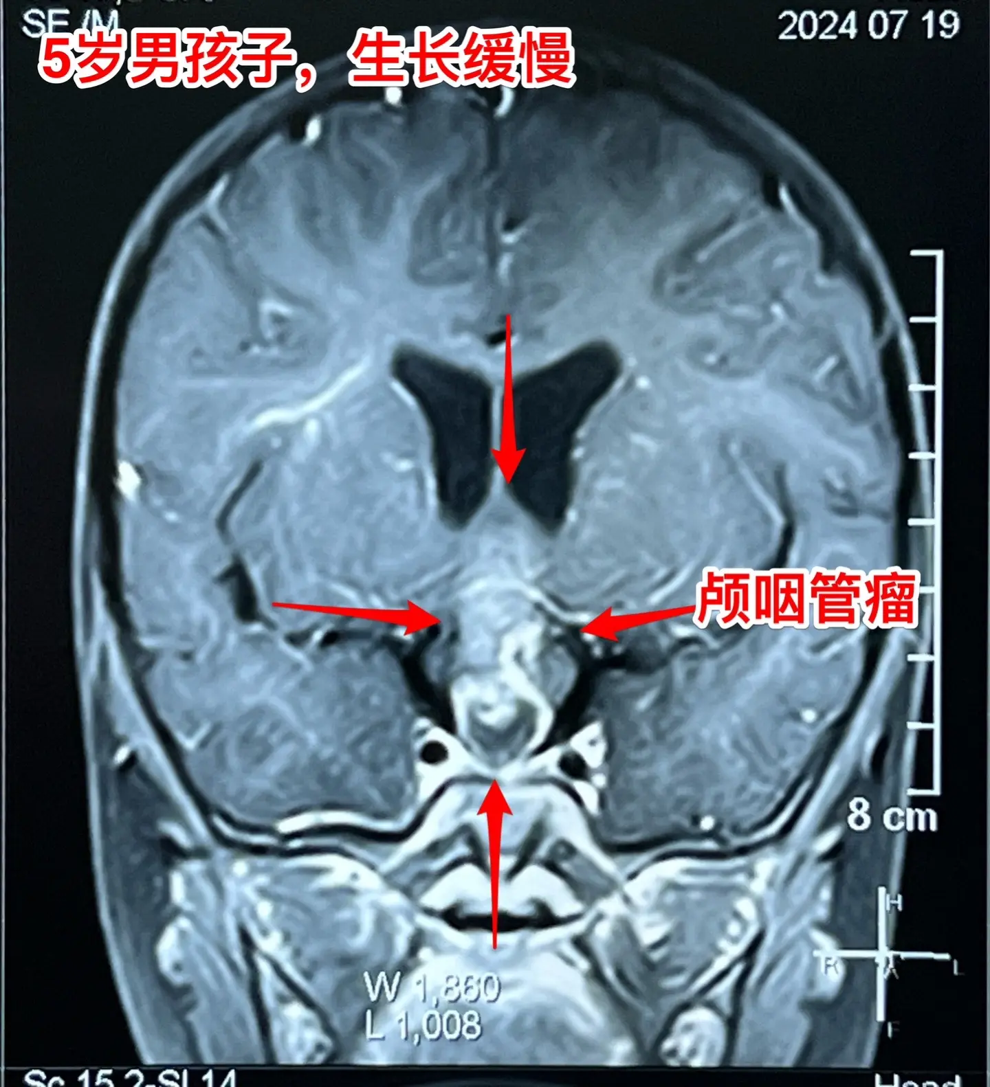 一天两台颅咽管瘤手术对于我们科是常态！7月24日我们科按常规安排了两台...