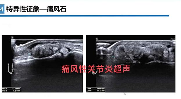 痛风性关节炎超声。