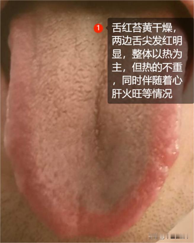 裂纹越重，毛病越多！常见的4大裂纹舌，一次给你讲明白
脾胃有热
热气太重的话，向