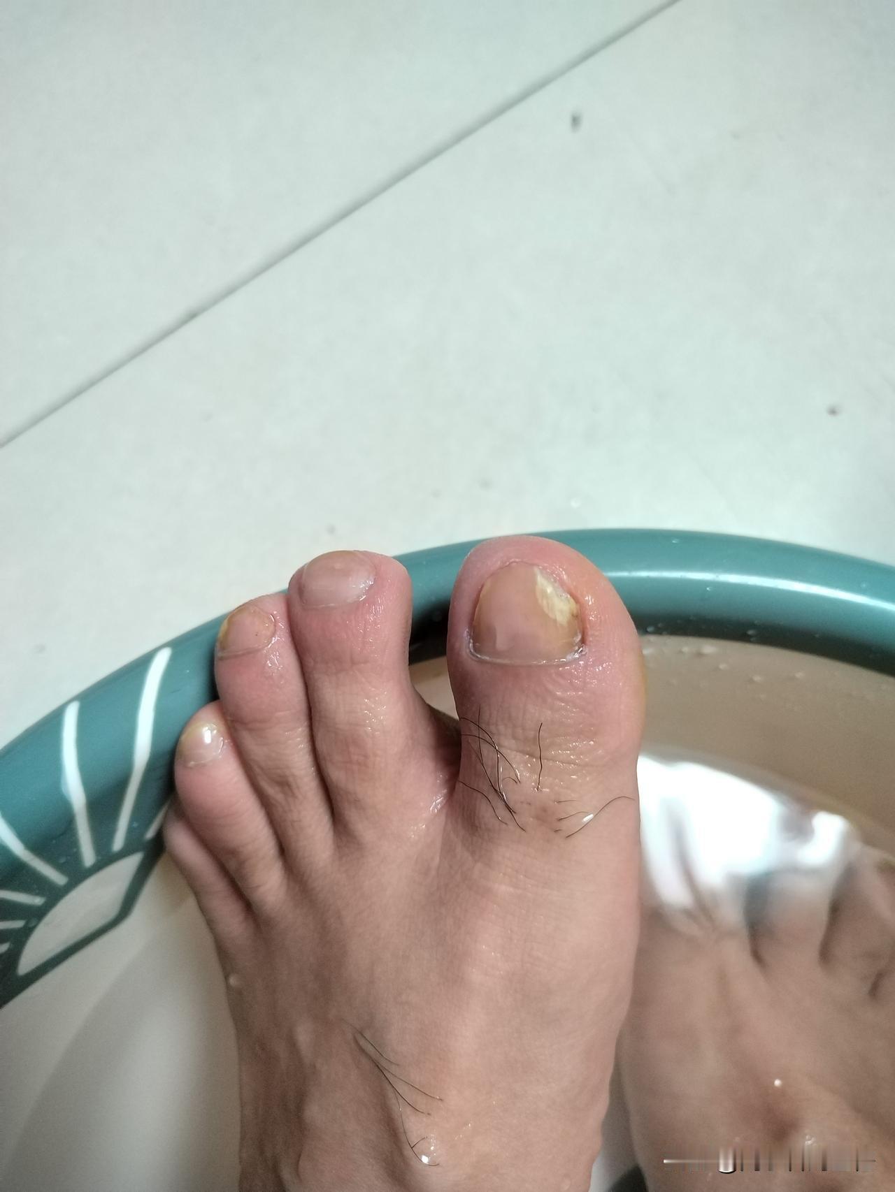 请教一下大家，这个是否就是传说中的“灰指甲”啊？以前看电视，有个广告:得了灰指甲