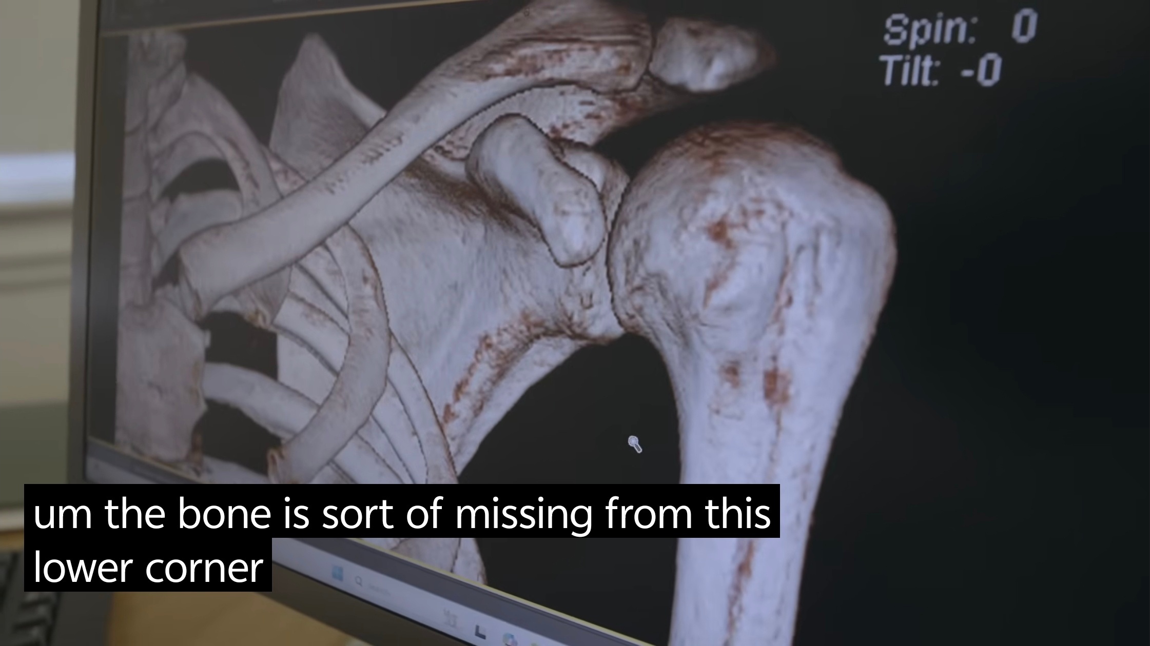 个人纪录片确认贝林在接受肩膀手术时已经出现骨缺损的情况肩关节稳定由骨性稳定和骨头