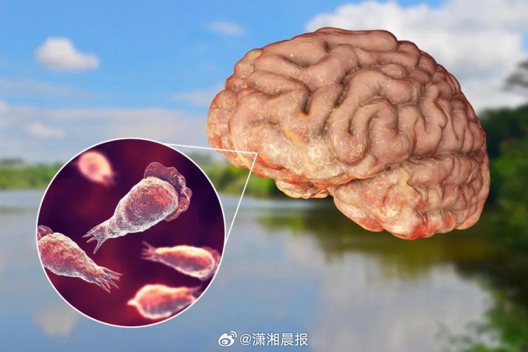 【#印度食脑虫感染病例数激增##印度食脑虫已致26人死亡#】近日，印度喀拉拉邦“