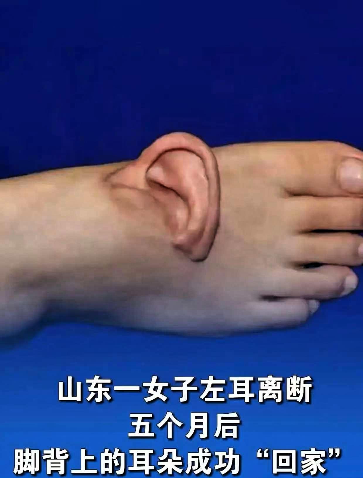 山东孙女士在厂里干活，设备坏了，左耳整个被扯下来，手里攥着那只耳朵送医院，到的时