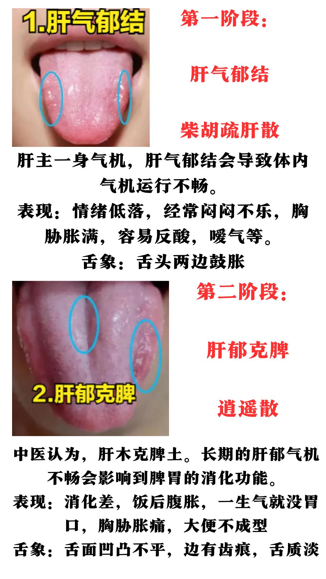 肝郁发展顺序：肝气郁结、肝郁克脾、肝郁化火、痰瘀互结，看舌象，对症调理！#中药#