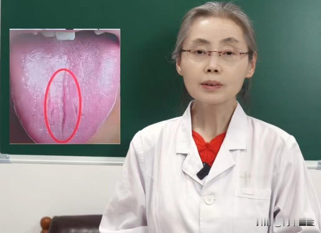 肝气郁结，肾米青亏虚，这种舌象直接进补，只会越补越虚

患者主诉：急躁易怒、腰酸
