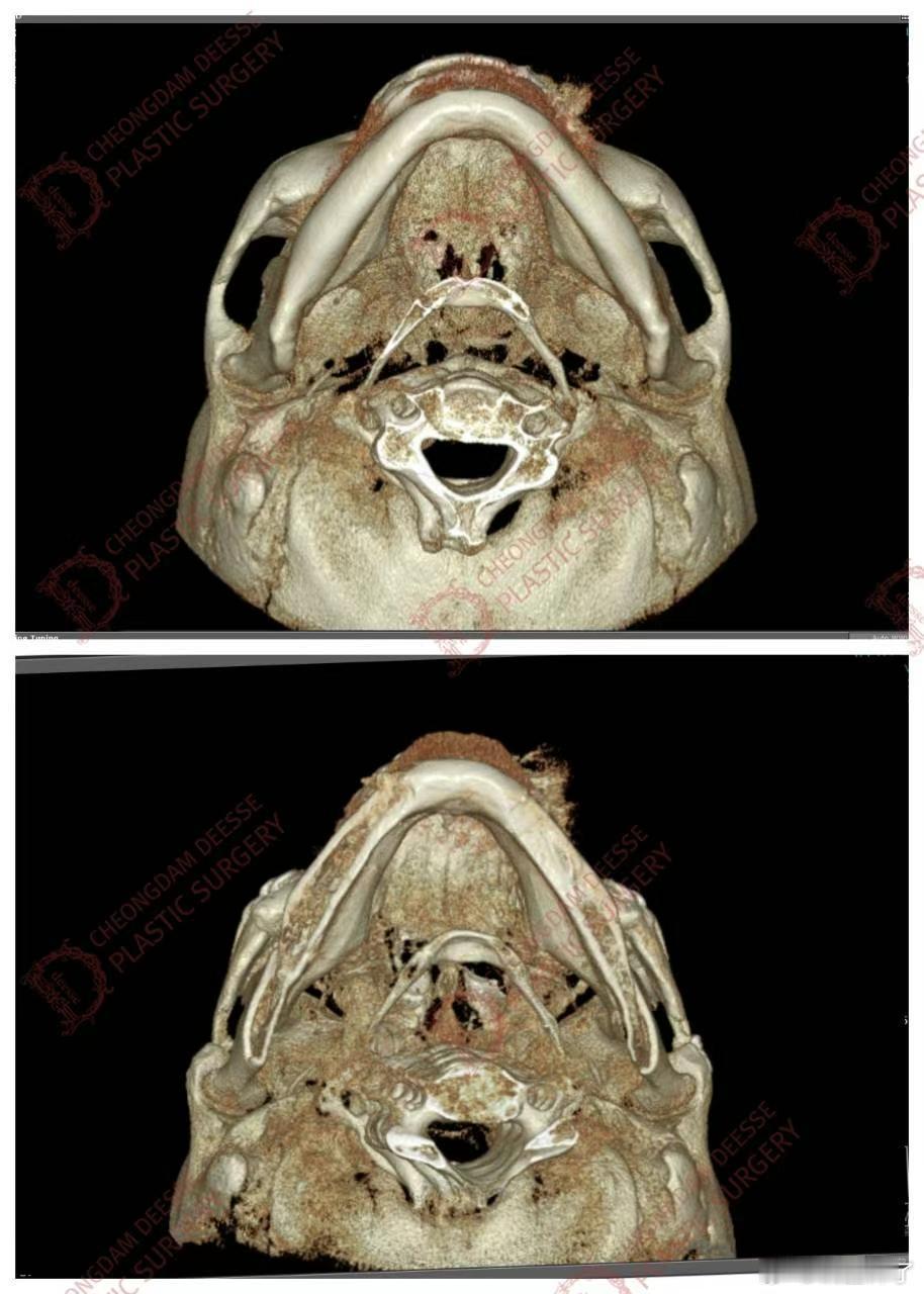 脸明显窄了，但没有那种“削过头”的违和感，还是保留了一点点骨感支撑，所以看起来更