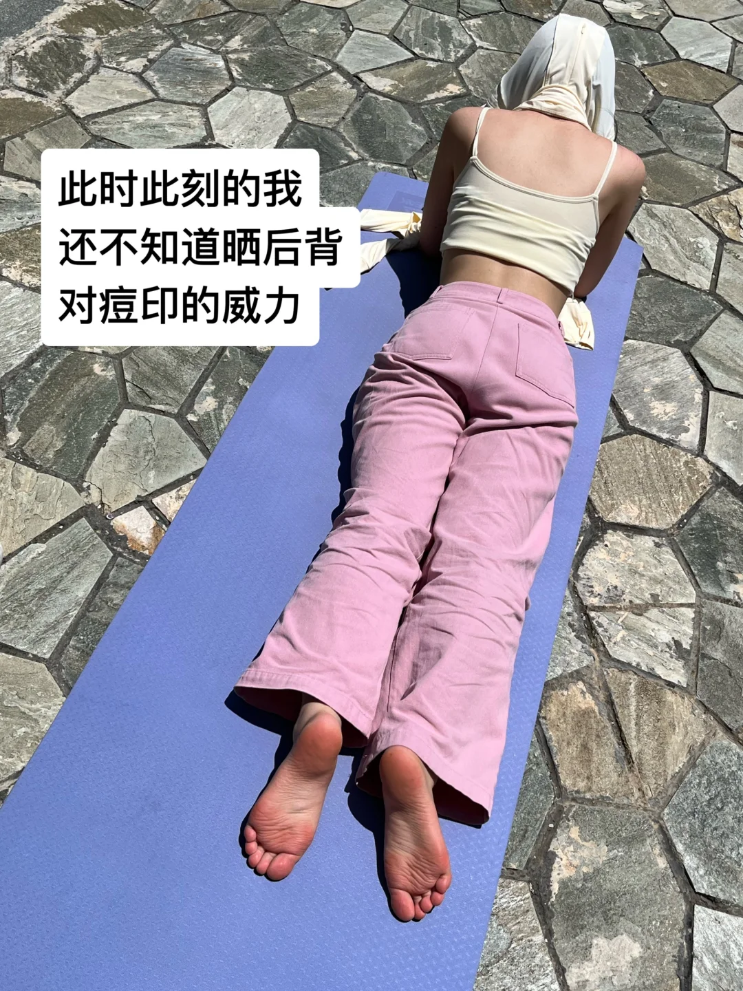 三伏天多晒背！痘印往后退！
