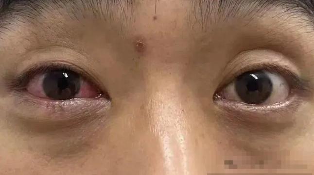 男子遇五步蛇想抓来玩被喷一脸毒
近日，杭州一男子周先生进山遇到五步蛇，想抓来玩，
