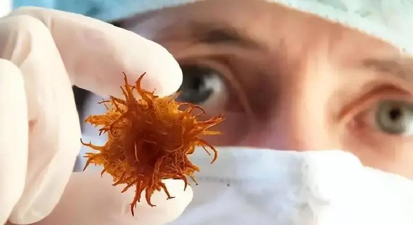 每天一根热狗，就能让结直肠癌风险猛增18%？肠道黏膜正悄然遭殃，这反差太扎心！