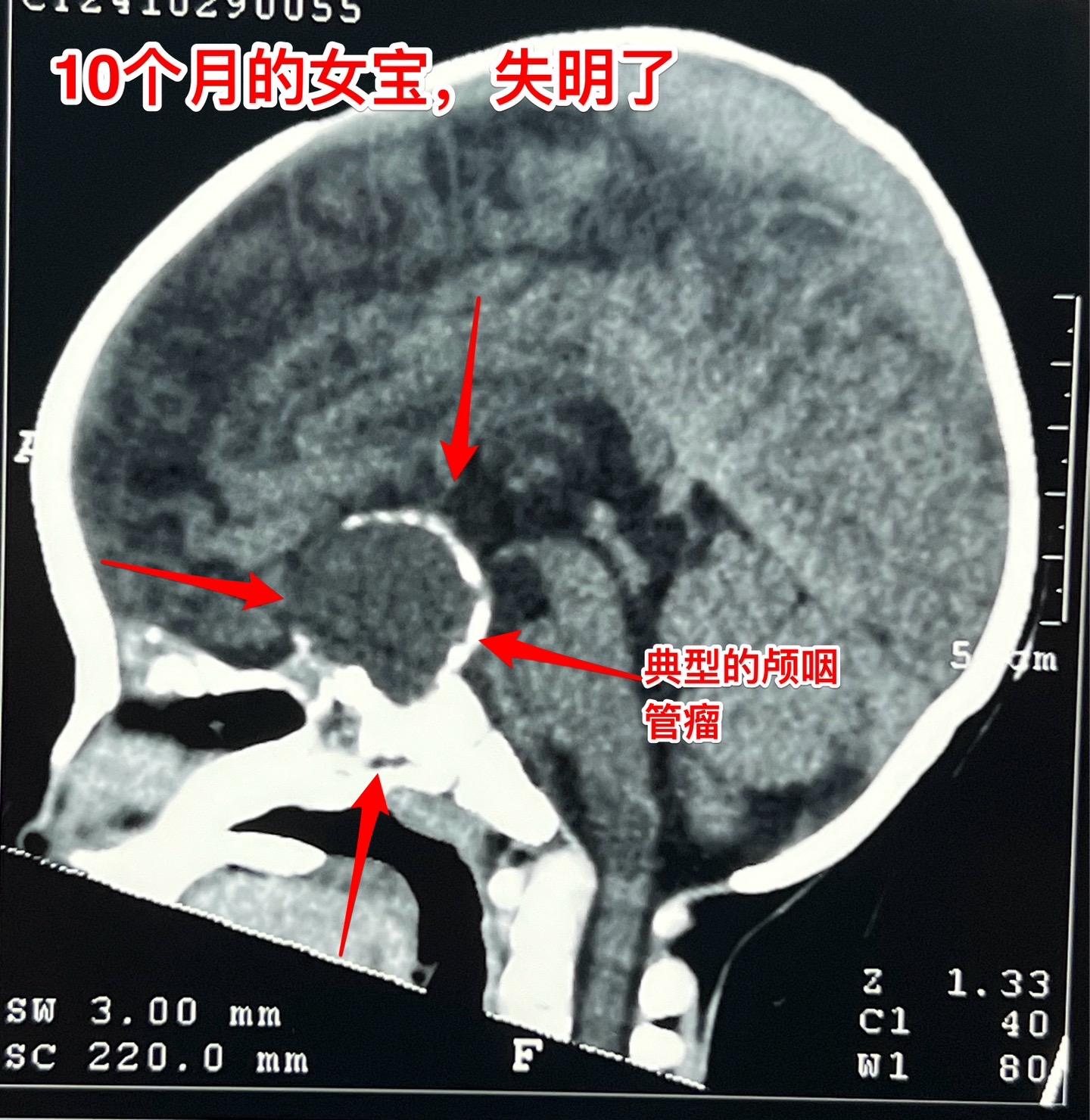 10个月大的宝宝视力下降能不能被家长发现。可以肯定，10个月大的宝宝...