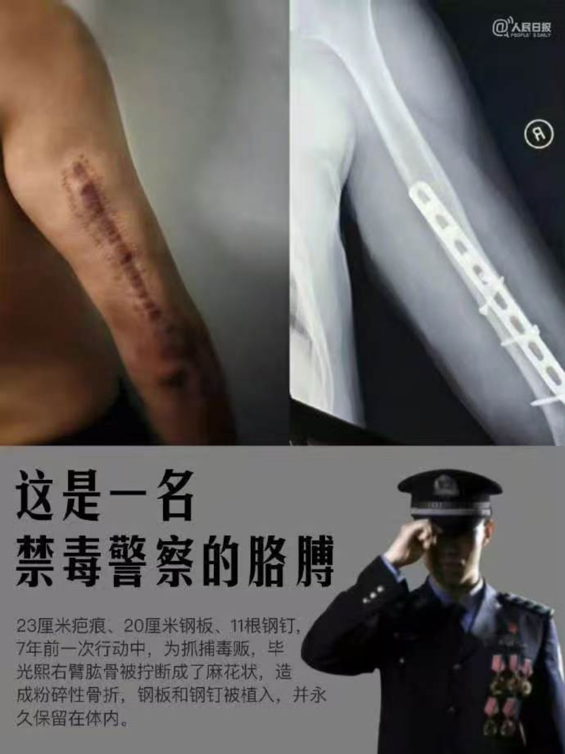 23厘米疤痕、20厘米钢板、11根钢钉，这是一名禁毒警察的胳膊。他说：“这是我的