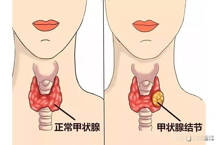 甲状腺结节西医否定中医很消除，中医反对西医遇到结节就手术，我支持中医偏多，我也认